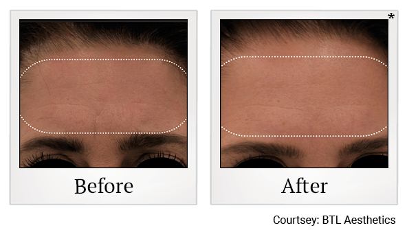 Results of EmFace treatment at True Form Medical Group in Oakland and Fremont