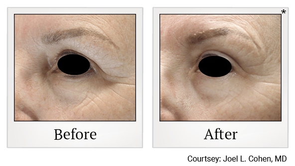 Results of EmFace treatment at True Form Medical Group in Oakland and Fremont