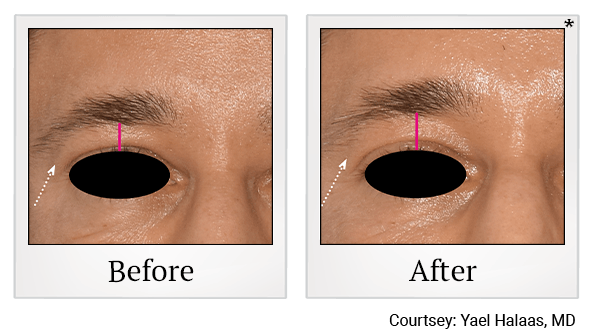 Results of EmFace treatment at True Form Medical Group in Oakland and Fremont