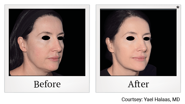 Results of EmFace treatment at True Form Medical Group in Oakland and Fremont