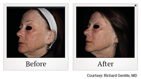 Results of EmFace treatment at True Form Medical Group in Oakland and Fremont