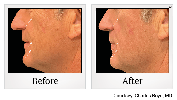 Results 21 of EmFace treatment at True Form Medical Group in Oakland and Fremont