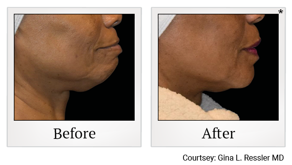 Results 7 of EmFace treatment at True Form Medical Group in Oakland and Fremont