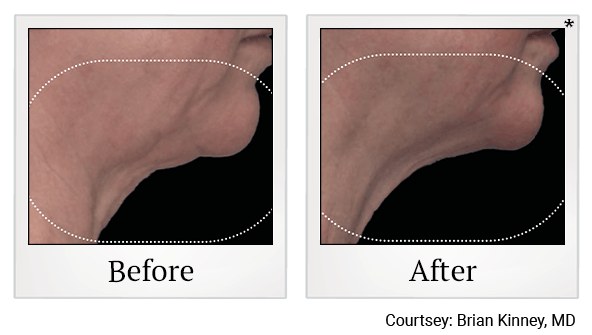 Results 8 of EmFace treatment at True Form Medical Group in Oakland and Fremont