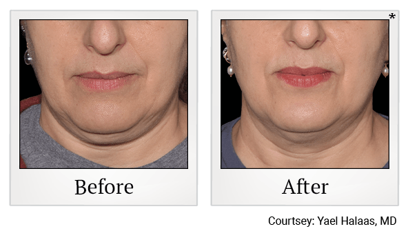 Results 9 of EmFace treatment at True Form Medical Group in Oakland and Fremont