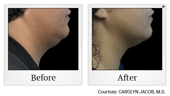 Results 11 of EmFace treatment at True Form Medical Group in Oakland and Fremont