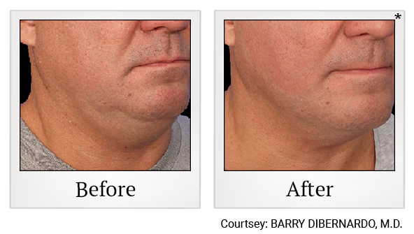 Results 13 of EmFace treatment at True Form Medical Group in Oakland and Fremont