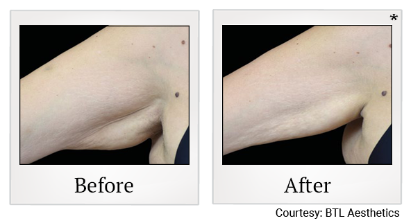 Results 4 of emtone treatment at True Form Medical Group in Oakland and Fremont