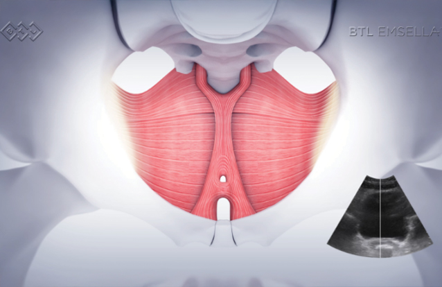 How Emsella works at True Form Medical Group in Oakland and Fremont
